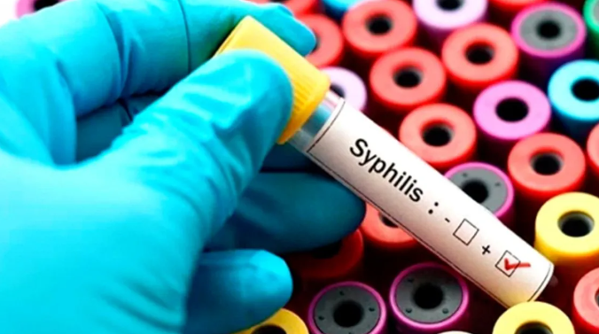Alerta de salud pública: la sífilis